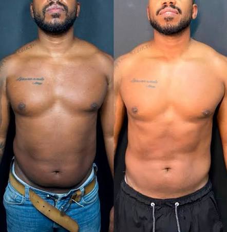 Antes e depois